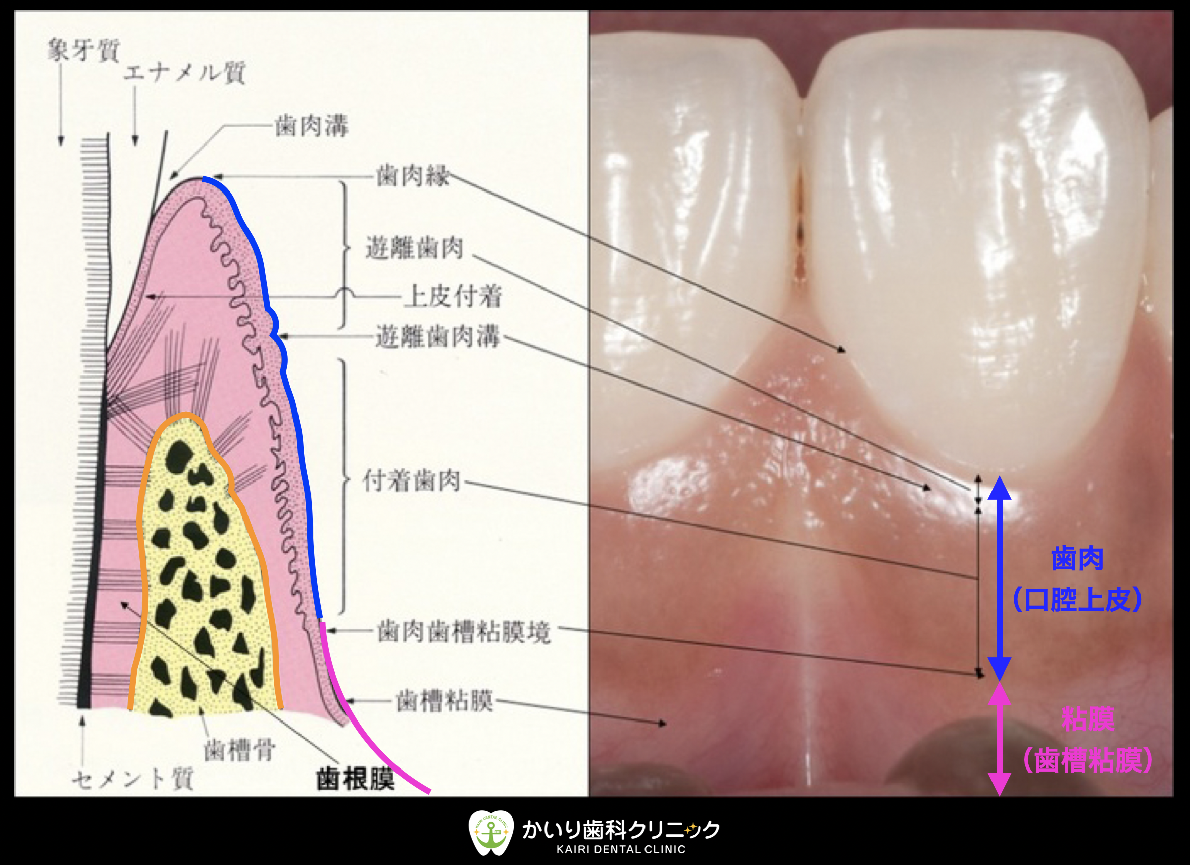 歯周病専門外来⑤〜歯ぐきが下がる状態（歯根露出・歯肉退縮